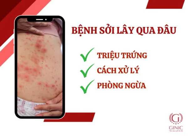 BỆNH SỞI LÂY QUA NHỮNG ĐƯỜNG NÀO? NGUYÊN NHÂN, TRIỆU CHỨNG VÀ CÁCH PHÒNG TRÁNH