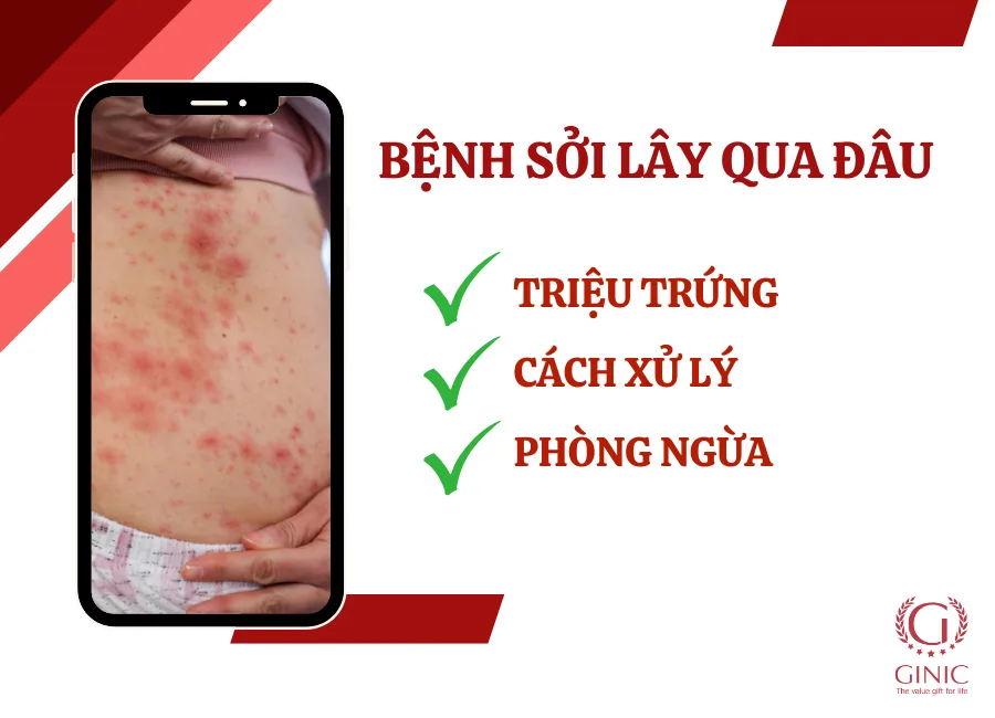 BỆNH SỞI LÂY QUA NHỮNG ĐƯỜNG NÀO? NGUYÊN NHÂN, TRIỆU CHỨNG VÀ CÁCH PHÒNG TRÁNH