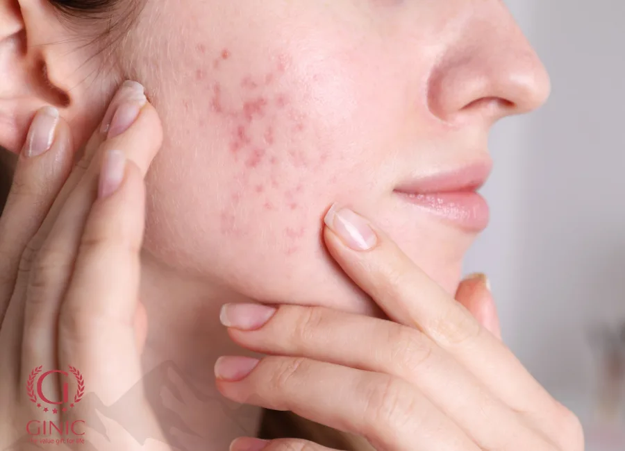 5 dấu hiệu điển hình cảnh báo rối loạn nội tiết tố nữ 5 dấu hiệu điển hình cảnh báo rối loạn nội tiết tố nữ
